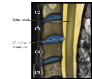 Demonstrative Evidence in a personal injury case by Baumgartner Law Firm