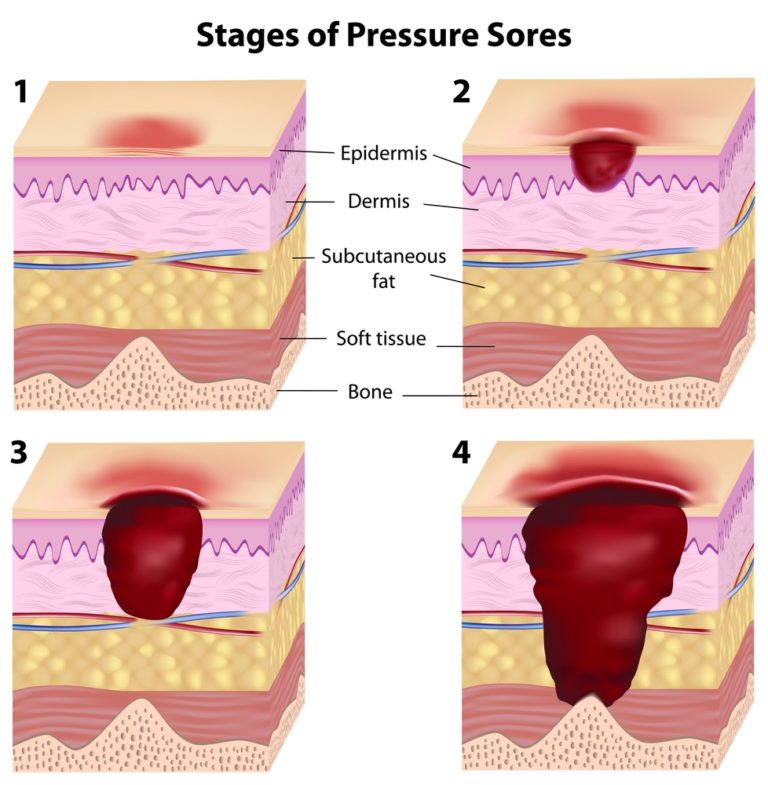 are-bedsores-an-indication-of-nursing-home-neglect-baumgartner-law-firm