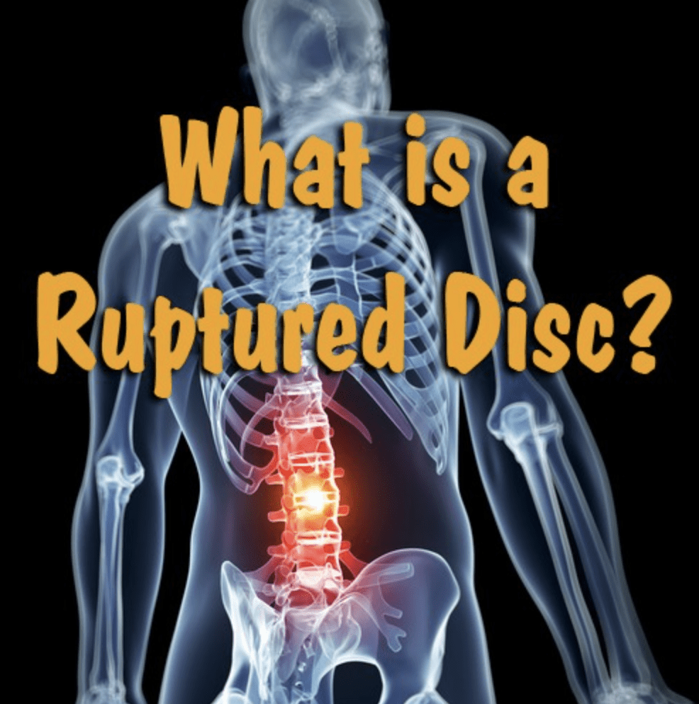 Ruptured Discs After a Car Accident and How it Impacts Compensation