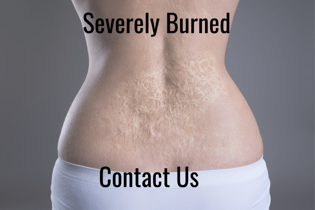 Electrical burn and arc flash claims - a severely burned back