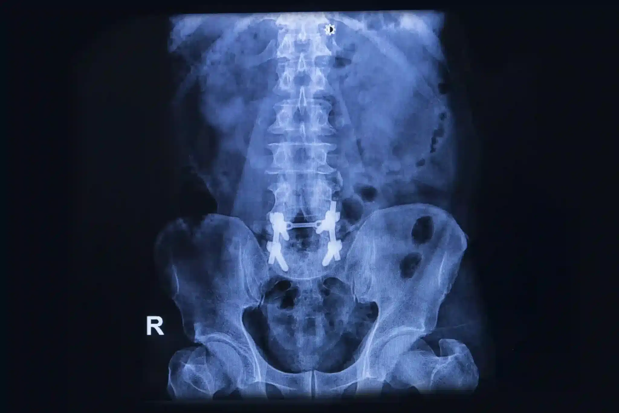 Who may be liable for your spinal cord injury?
