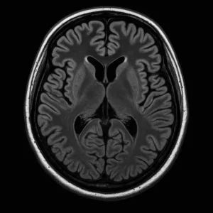 Traumatic Brain Injury 