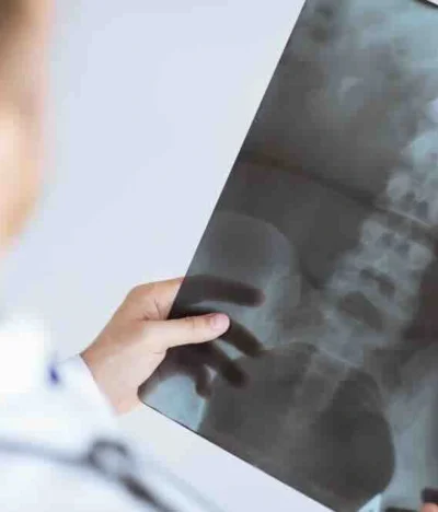 What Happens If a Car Accident Aggravates a Pre-Existing Condition in Texas