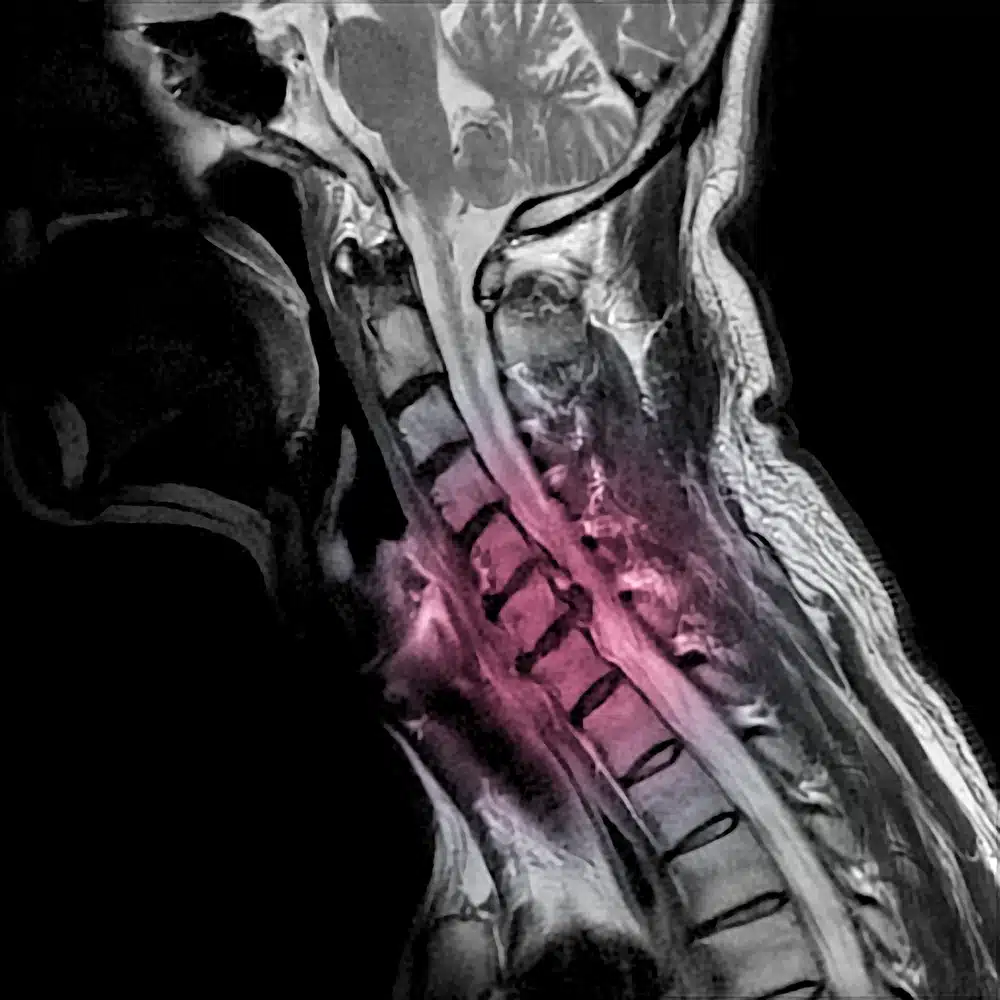 herniated and bulging discs
